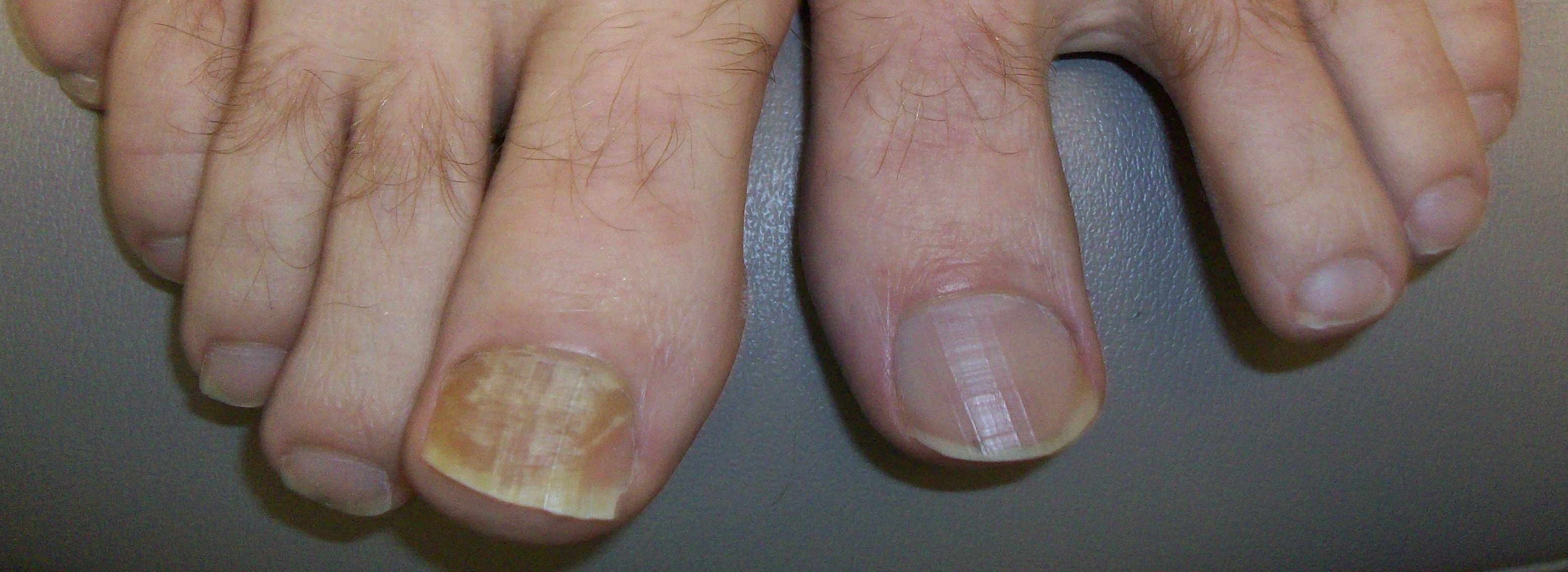 home-remedies-for-toenail-fungus-top-10-home-remedies