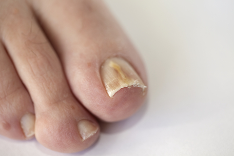 The Diagnosis and Treatment of Nail Disorders. - Abstract - Europe PMC
