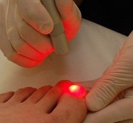 Laser-Treatment-For-Toenail-Fungus